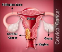 Kanker Serviks/ Leher Rahim/ Mulut Rahim